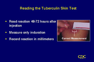 Slide 32: Reading the Tuberculin Skin Test. Click for larger version.