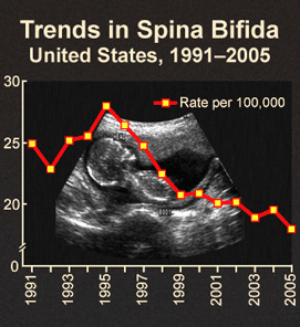 Trends in Spina Bifida. United States, 1991 - 2005