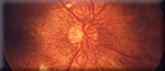 A photo of an eye with diabetic retinopathy