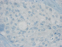 Breast cancer cells without estrogen receptor.