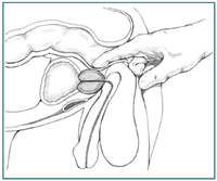 Cross-section diagram of digital rectal exam showing patient's lower urinary tract and rectum. The doctor's index finger is inserted into the patient's rectum to feel the size and shape of the prostate.