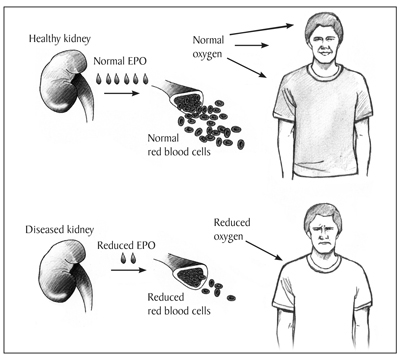 Diagram showing the process of red blood cell production in a person with healthy kidneys and a person with diseased kidneys. On the top half of the diagram, on the left side, a kidney labeled “Healthy kidney” starts the process by producing EPO. Six drops represent “Normal EPO.” An arrow beneath the EPO drops points from the kidney to a cross section of a bone. Several cells labeled “Normal red blood cells”  are spilling out of the bone marrow. Above the red blood cells, the label “Normal oxygen,” with three arrows pointing to the head and torso of a smiling man, indicates the man is receiving enough oxygen. On the bottom half of the diagram, on the left side, a kidney labeled “Diseased kidney” produces only two drops, labeled “Reduced EPO.” Under the EPO drops, an arrow points to the cross section of a bone. A small number of cells, labeled “Reduced blood cells,” are spilling out of the bone marrow. Above the red blood cells, the label “Reduced oxygen,” with one arrow pointing to the head and torso of a frowning man, indicates the man is not receiving enough oxygen.