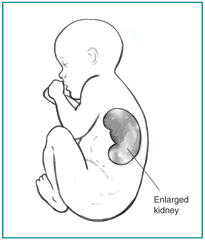Diagram of fetus with enlarged kidney visible as seen in an ultrasound.