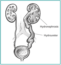 Front-view diagram of urinary tract with blockage. One ureter and kidney are swollen. The swollen ureter is labeled.