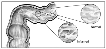 Drawing of the lining of the intestine showing normal tissue and inflamed tissue.