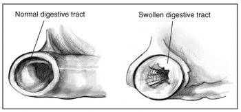 Cross-section image of a normal digestive tract and a swollen digestive tract. The swollen digestive tract has a narrow passage.
