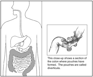 Drawing of digestive tract with the colon highlighted.  Next to it is a close-up section of the colon with diverticula, or pouches.