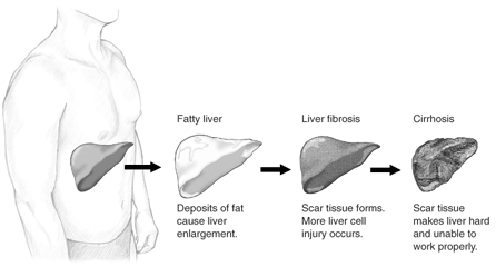 Illustration of the stages of liver damage including: normal liver, fatty liver (where deposits of fat cause liver enlargement), liver fibrosis (where scar tissue forms and more liver cell injury occurs), and cirrhosis (where scar tissue makes liver hard and unable to work properly).