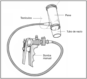Dibujo de un dispositivo de vació usado para la erección del pene
