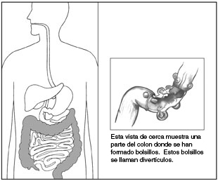 Ilustración del sistema digestivo resaltando el colon. A un lado hay una sección en primer plano del colon don divertículos o bolsillos.