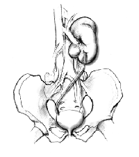 Anatomic drawing of bladder, ureters, and fused kidneys.  The kidney that would normally be on the left side of the picture has crossed over and fused with the kidney on the right.