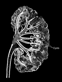 Drawing of a medullary sponge kidney as seen in an intravenous pyelogram. The background is black. The large part of the kidney appears to be porous, like a sponge. Two white spots on the kidney are circled. A label identifies the white spots as cysts.
