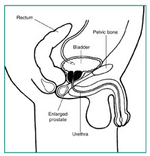 Drawing of the side view of the male urinary tract showing how an enlarged prostate can squeeze the urethra and block urine flow. Labels point to the rectum, bladder, pelvic bone, enlarged prostate, and urethra.