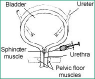 Illustration of collagen injection, showing bladder, ureter, sphincter muscle with needle, urethra, and pelvic floor muscles