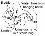 Illustration of a foley catheter, showing the bladder and urethra, and where water flows from hanging bottle and urine drains into sterile bag