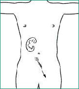 Illustration of urostomy, showing urine escaping through the skin