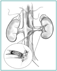 Anatomic drawing of the kidneys. An inset shows a magnified cross-section of the renal artery. Plaque is building up on the inner wall of the artery and blocking blood flow to the kidney.