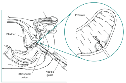 Cross-section diagram of transrectal prostate biopsy with ultrasound probe inserted into the rectum. A biopsy needle extends from the probe. An inset shows larger view of the needle tip in the prostate.