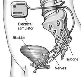 Drawing of a side view of the lower torso with an implanted electrical stimulator. A wire from the electrical stimulator is attached to the tailbone and delivers mild electrical pulses to the nerves that control bladder function. Labels point to the electrical stimulator, tailbone, nerves, and bladder.