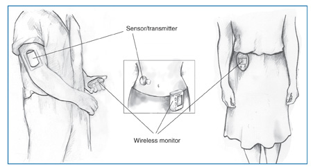 Drawing of three people, each using a different type of wireless continuous glucose monitoring system. A man on the left wears a glucose sensor/transmitter on his right arm and holds a monitor in his left hand. In the middle drawing, a woman’s torso is shown with a sensor/transmitter attached to her abdomen and a monitor attached to her clothing. A woman on the right wears a third type of monitor outside her clothing; the sensor/transmitter is worn beneath her clothing so it is not pictured.