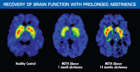 Recovery of Brain Function With Prolonged Abstinence image