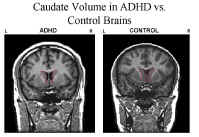 ADHD MRI