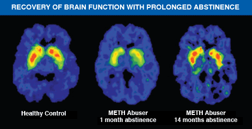 Recovery of Brain function graphic