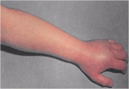 Erythema from radiation