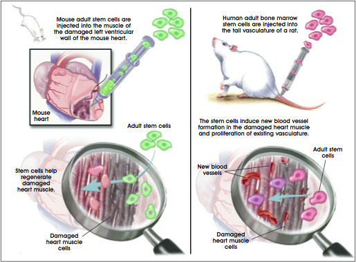 Heart Muscle Repair with Adult Stem Cells
