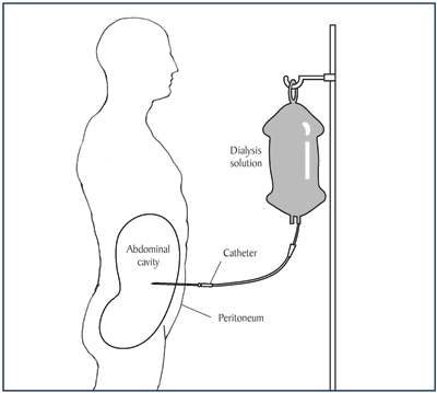 Illustration of a patient receiving peritoneal dialysis.