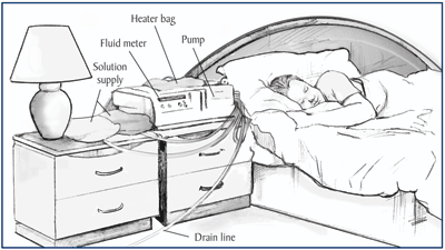 Drawing of patient sleeping in bed.  A peritoneal dialysis cycler is on the dresser beside the bed.  Labels indicate the heater bag sitting on top of the cycler, two bags of fluid beside the cycler, a drain line running from the cycler to the bathroom, and parts of the cycler, including the pump and fluid meter.