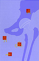 Conference artwork depicting an figue of a a hip replacement with small icons of people doing activities (biking, swimming, etc.) around the periphery. 