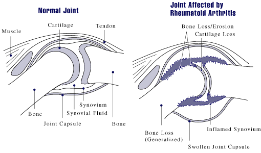 Picture of a Normal Joint and a Joint affected by Rheumatoid Arthritis