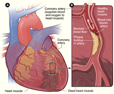 Illustration showing an overview of a heart and coronary artery showing damage caused by a heart attack. The illustration also shows a cross-section of the coronary artery with plaque buildup and a blood clot.