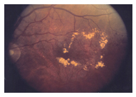 A close-up photo of an eye with diabetic macular edema.