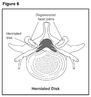 Herniated Disk