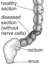 Illustration of the intestine showing a healty section and a diseased section following the anus.