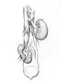 Anatomic drawing of bladder, ureters, and kidneys.  The kidney on the right of the picture is in the normal position, several inches above the bladder.  The kidney on the left is an ectopic kidney, just a couple of inches from the bladder.