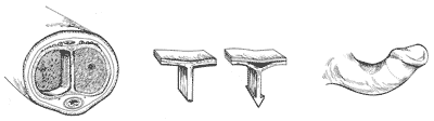 A cross-section of the penis (left) displays the internal cavity that runs the length of the penis and is divided into two chambers (corpora cavernosa) by a vertical connecting tissue known as a septum. It is believed that, during trauma such as bending, bleeding might occur at a point of attachment of the septum to tissue lining the chamber wall (center). The bleeding results in a hard scar, which is characteristic of Peyronie’s disease. The scar reduces flexiblility on one side of the penis during erection, leading to curvative (right).