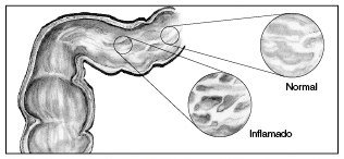Ilustración del revestimiento del intestino delineando el tejido normal y el tejido inflamado.