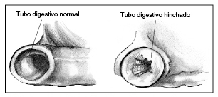  Ilustración de una sección del tracto digestivo normal y un tracto digestivo inflamado. El tracto digestivo inflamado tiene un pasaje estrecho.