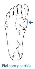 Pie con piel seca y partida