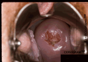 A screenshot of NCI Uterine Cervix Images.