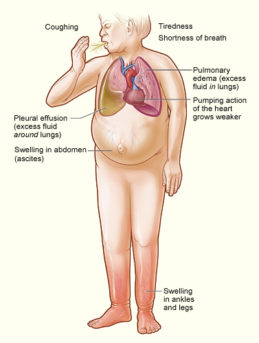 Illustration showing the major signs and symptoms of heart failure.