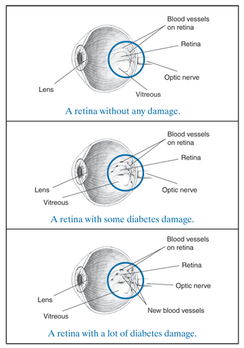 Drawing of a cross section of an eye showing no diabetes damage with the retina, blood vessels on the retina, the optic nerve, the vitreous, and the lens labeled. Drawing of a cross section of an eye showing some diabetes damage with the retina, blood vessels on the retina, the optic nerve, the vitreous, and the lens labeled. Drawing of a cross section of an eye showing a lot of diabetes damage with the retina, blood vessels on the retina, the optic nerve, new blood vessels, the vitreous, and the lens labeled.