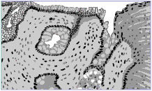 Drawing of a microscopic piece of the esophagus showing the abnormal tissue of Barrett’s esophagus.