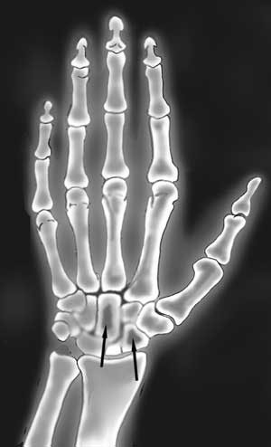 An X-ray of a hand.