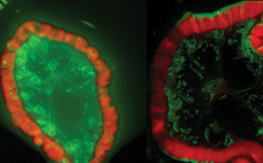 picture of metastatic ovarian cancer cells