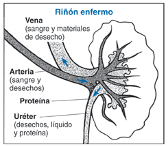 Ilustración del corte transversal de un riñón enfermo sus partes y funciones etiquetadas.