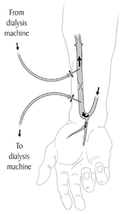 Illustration of an arm in the process of arteriovenous fistula (AV)